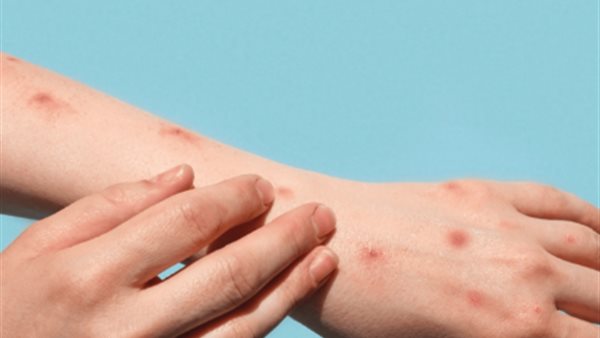 أعراض جدري القرود