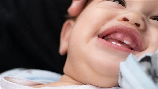 أسباب اعوجاج الأسنان