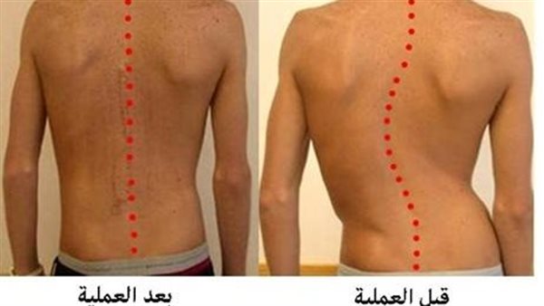 علاج داء شيرمان