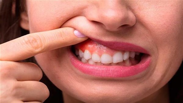 صحة اللثة.. أرشيفية