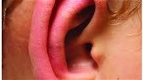 ما سبب حرارة واحمرار