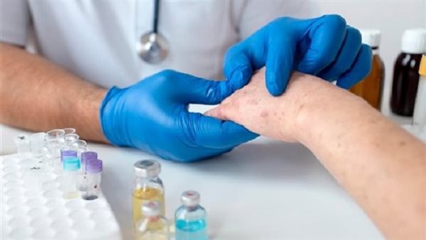 علاج حساسية اللاتكس