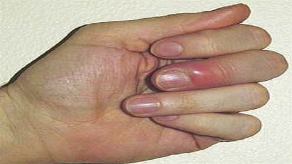 أعراض داء الأسبست