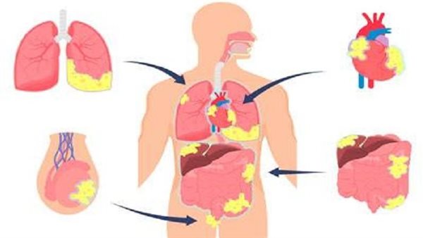 أعراض ورم المتوسطة