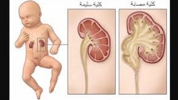 كيف يتم علاج توسع