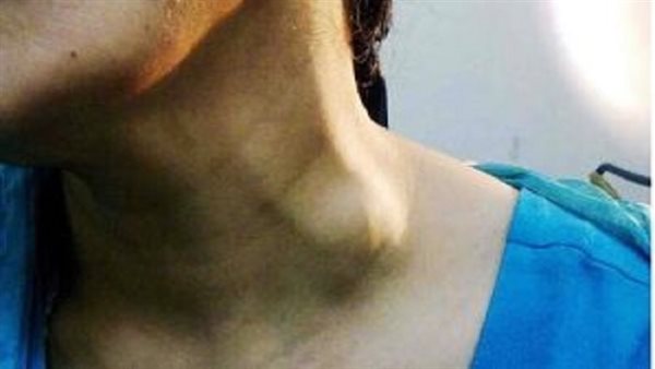 أسباب انتفاخ الوريد