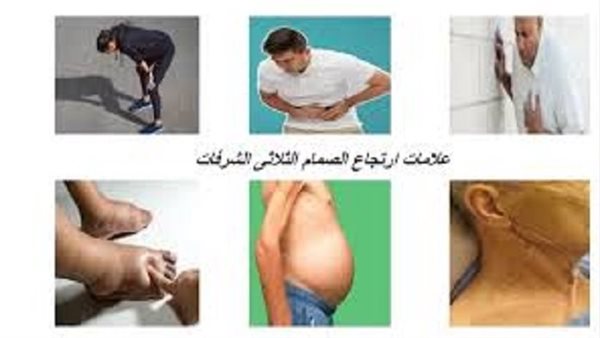 أعراض ارتجاع الصمام