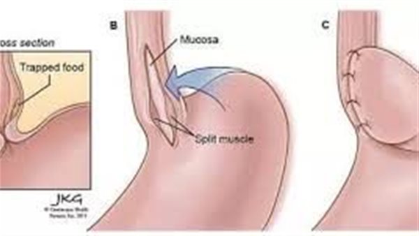 متلازمة ألجروف