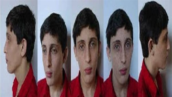 كيف يتم تشخيص متلازمة