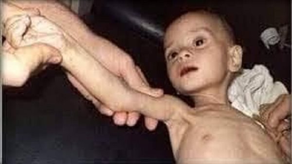 ما هو علاج مرض الماراسموس؟