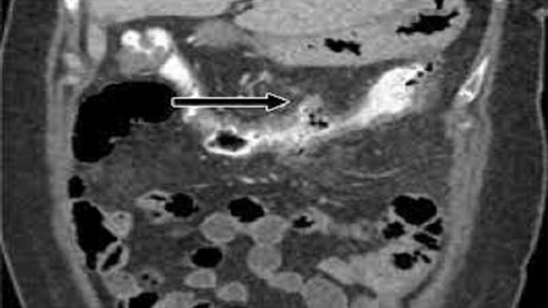 كيف يتم تشخيص التهاب