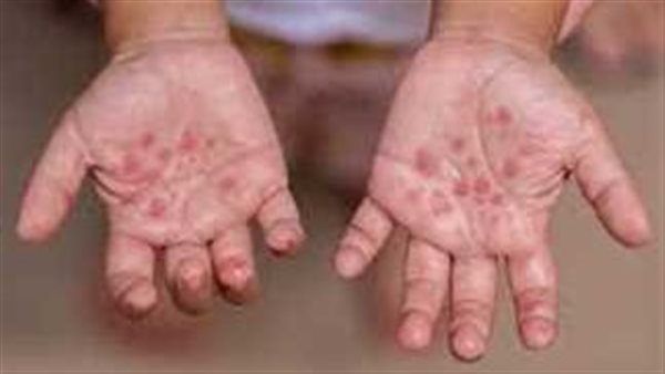 5 أعراض لفيروس HFMDعلى