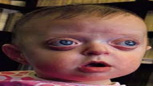 ما هي متلازمة فايفر؟